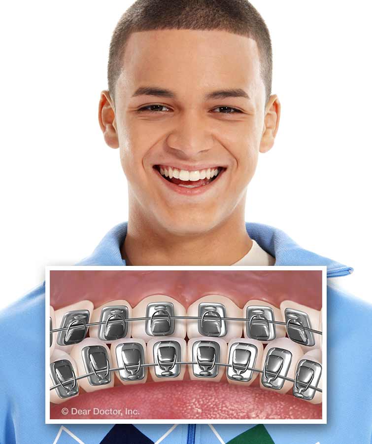 Lingual Braces.